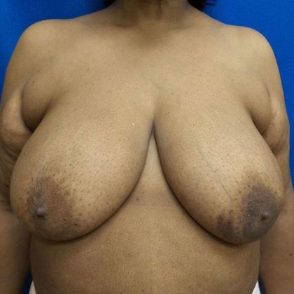 Implant Breast Reconstruction: Case 5 - Before