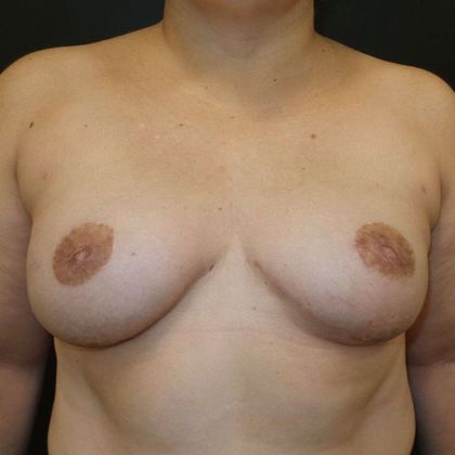 Implant Breast Reconstruction Case 8 - After