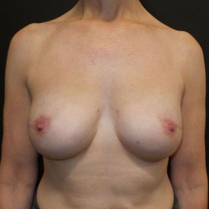Implant Breast Reconstruction Case 9 - After