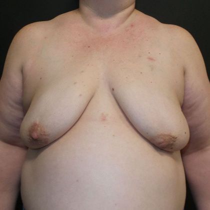 Implant Breast Reconstruction Case 11 - Before