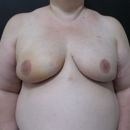 Implant Breast Reconstruction Case 11 - After