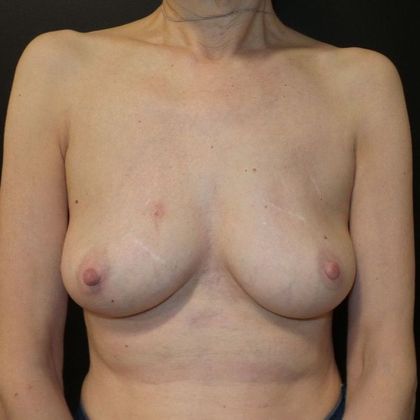 Implant Breast Reconstruction Case 12 - Before