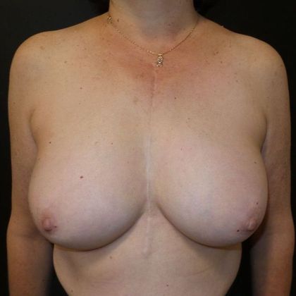 Implant Breast Reconstruction Case 13 - Before