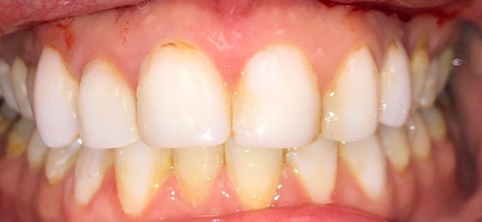 Smile Makeovers Case 12 - Before