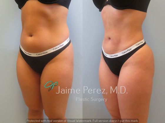 Lipo 360 Orlando  Liposuction 360 Florida