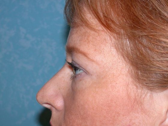 Eye Lift (Blepharoplasty): ULB1404 - Oregon, OH - Before
