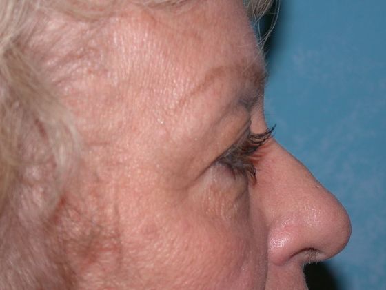 Eye Lift (Blepharoplasty): ULB1309 - Bowling Green, OH - Before