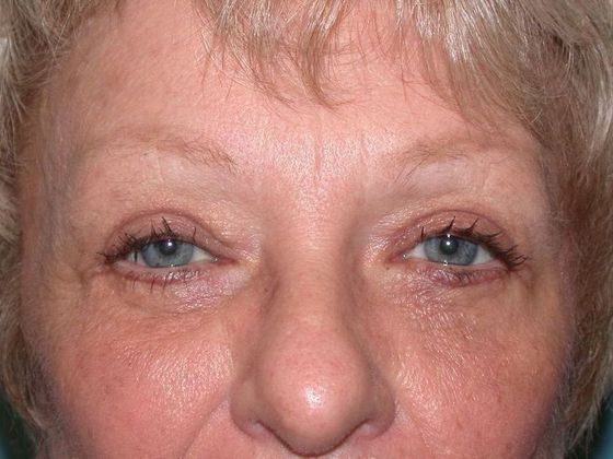 Eye Lift (Blepharoplasty) ULB1309 - Bowling Green, OH - After