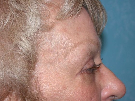 Eye Lift (Blepharoplasty): ULB1309 - Bowling Green, OH - After