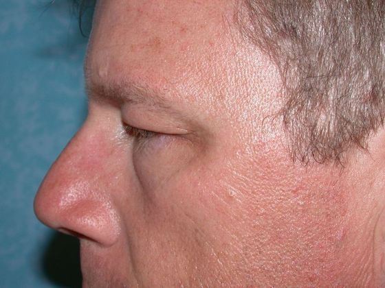 Eye Lift (Blepharoplasty): Case 1312- Petersburg, MI - Before