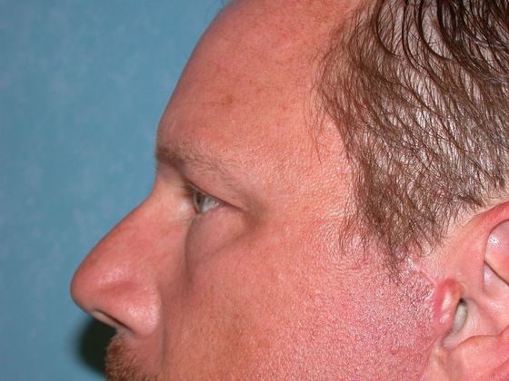 Eye Lift (Blepharoplasty): Case 1312- Petersburg, MI - After