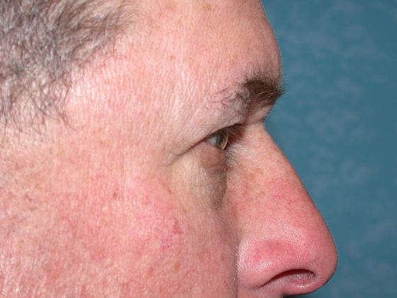 Eye Lift (Blepharoplasty): ULB1314 - Berkey, OH - Before