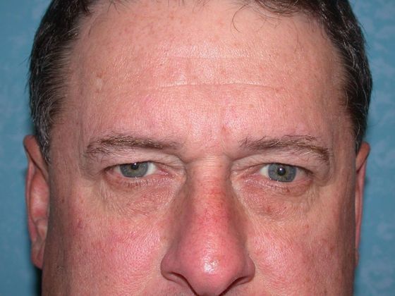Eye Lift (Blepharoplasty) ULB1314 - Berkey, OH - Before