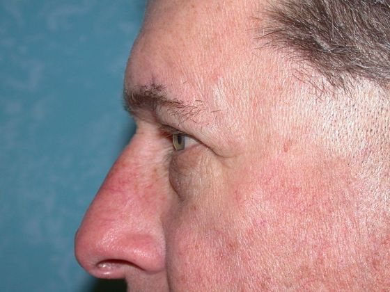 Eye Lift (Blepharoplasty): ULB1314 - Berkey, OH - Before