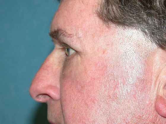 Eye Lift (Blepharoplasty): ULB1314 - Berkey, OH - After