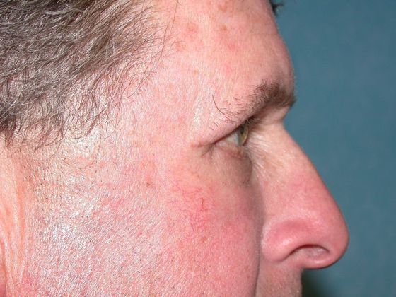 Eye Lift (Blepharoplasty): ULB1314 - Berkey, OH - After