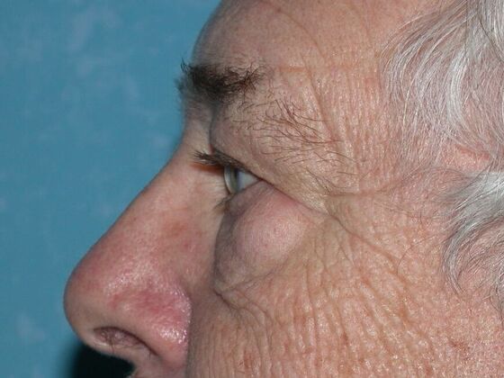 Eye Lift (Blepharoplasty): ULB1553 - Monroe, MI - Before