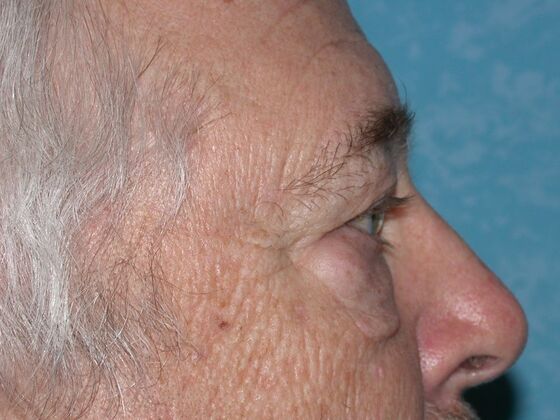 Eye Lift (Blepharoplasty): ULB1553 - Monroe, MI - Before