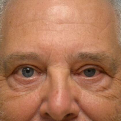 Eye Lift (Blepharoplasty) ULB1553 - Monroe, MI - After