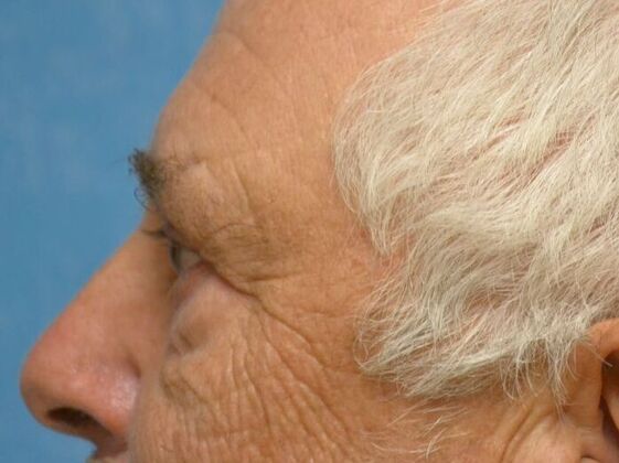 Eye Lift (Blepharoplasty): ULB1553 - Monroe, MI - After