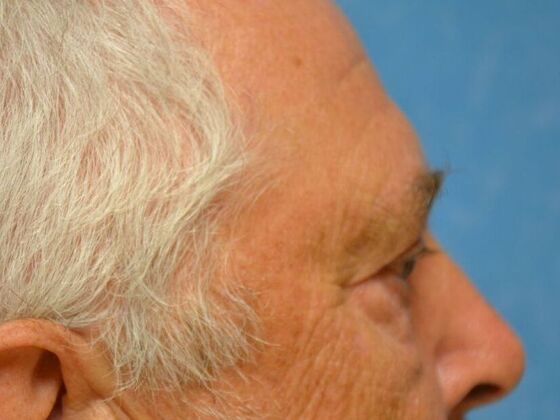 Eye Lift (Blepharoplasty): ULB1553 - Monroe, MI - After