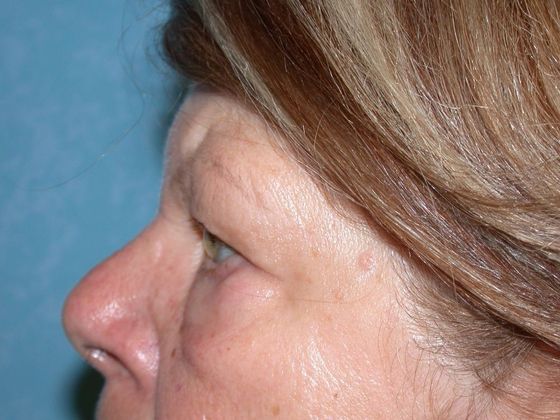 Eye Lift (Blepharoplasty): ULB1457 - Neapolis, OH - Before