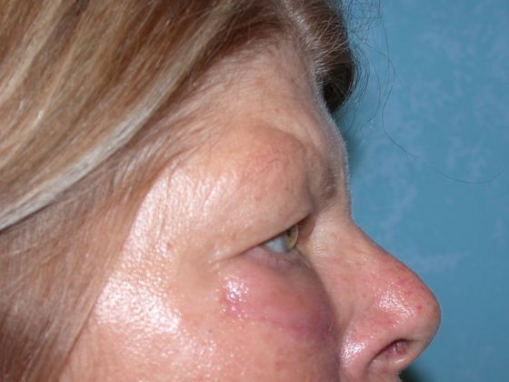 Eye Lift (Blepharoplasty): ULB1457 - Neapolis, OH - Before