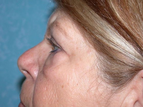 Eye Lift (Blepharoplasty): ULB1457 - Neapolis, OH - After