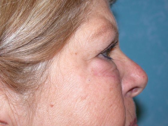 Eye Lift (Blepharoplasty): ULB1457 - Neapolis, OH - After