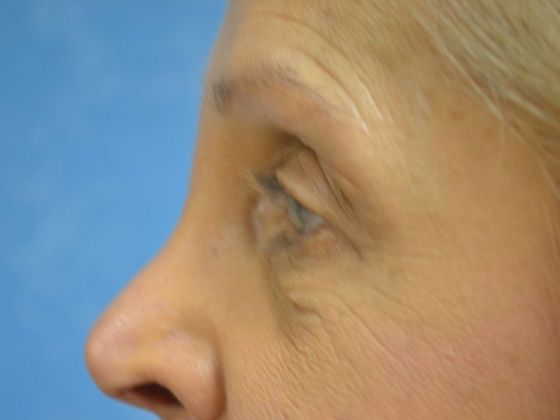 Eye Lift (Blepharoplasty): Case 1559- Toledo, OH - Before