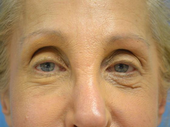 Eye Lift (Blepharoplasty) Case 1559- Toledo, OH - Before