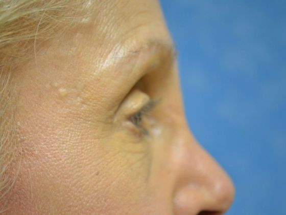 Eye Lift (Blepharoplasty): Case 1559- Toledo, OH - Before