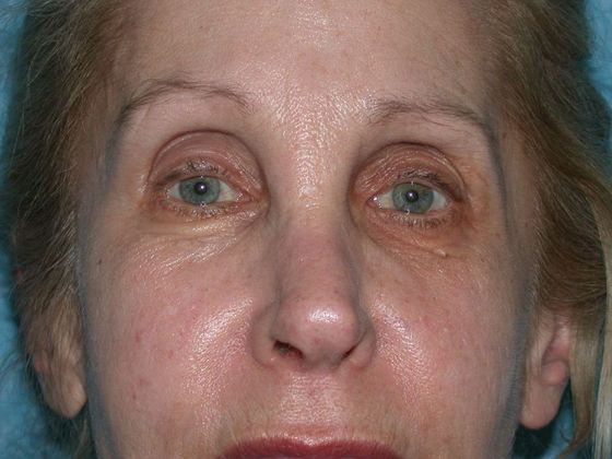 Eye Lift (Blepharoplasty) Case 1559- Toledo, OH - After