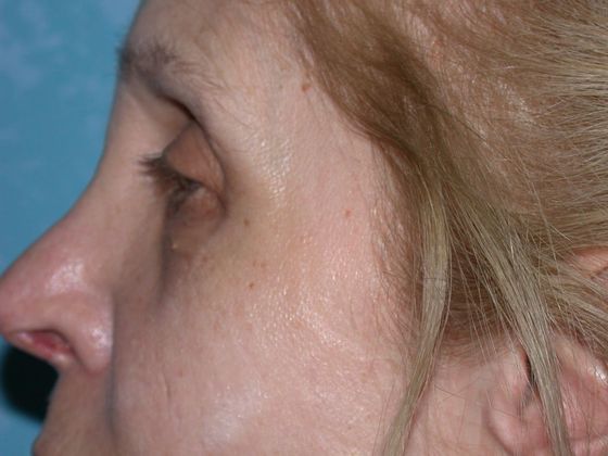 Eye Lift (Blepharoplasty): Case 1559- Toledo, OH - After