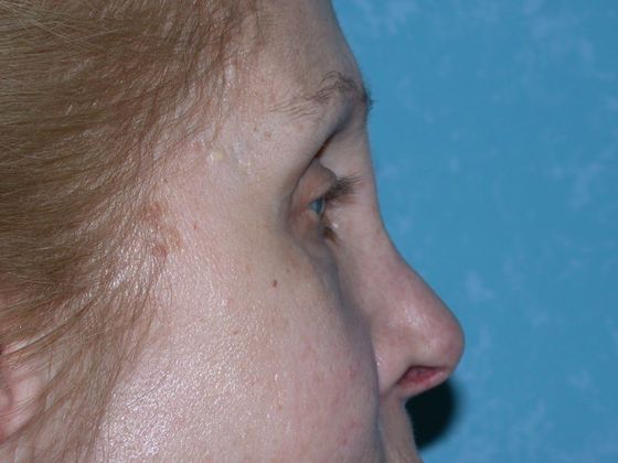 Eye Lift (Blepharoplasty): Case 1559- Toledo, OH - After