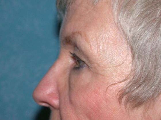 Eye Lift (Blepharoplasty): ULB1564 - Whitehouse, OH - Before