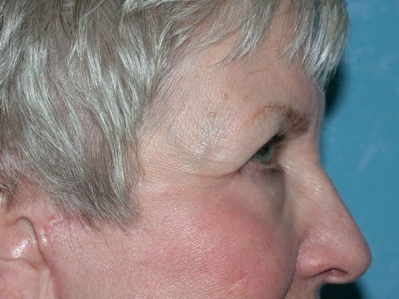 Eye Lift (Blepharoplasty): ULB1564 - Whitehouse, OH - After