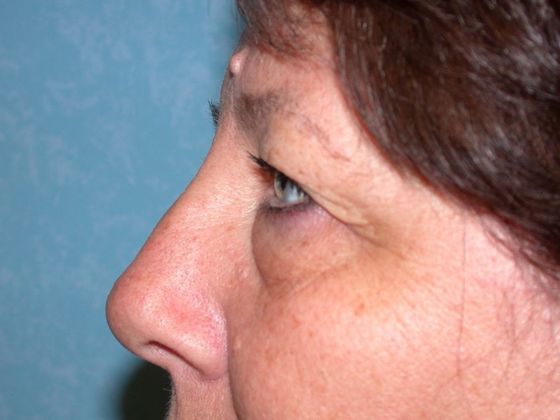 Eye Lift (Blepharoplasty): ULB1466 - Toledo Oh - Before