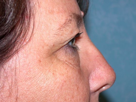 Eye Lift (Blepharoplasty): ULB1466 - Toledo Oh - Before