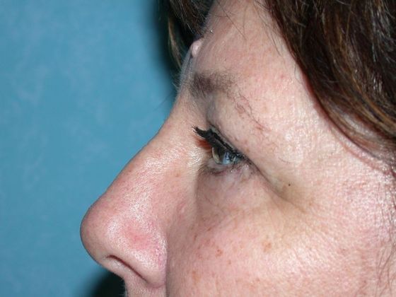 Eye Lift (Blepharoplasty): ULB1466 - Toledo Oh - After