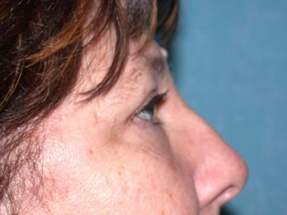 Eye Lift (Blepharoplasty): ULB1466 - Toledo Oh - After