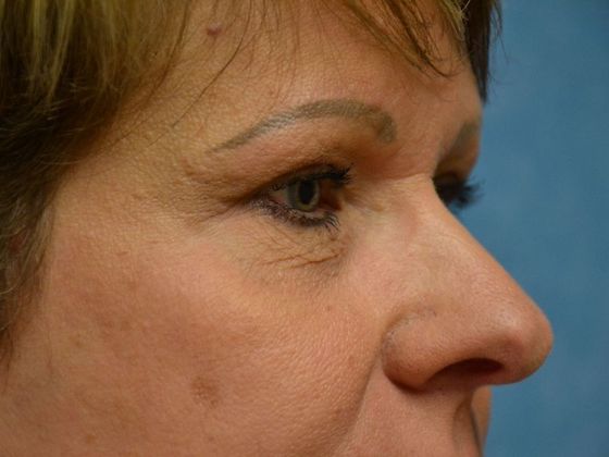Eye Lift (Blepharoplasty): ULB1670 - Holland, OH - After