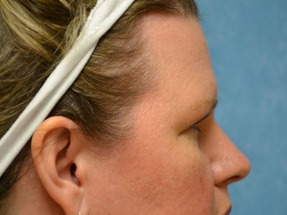 Eye Lift (Blepharoplasty): ULB1775 - Bowling Green, OH - Before