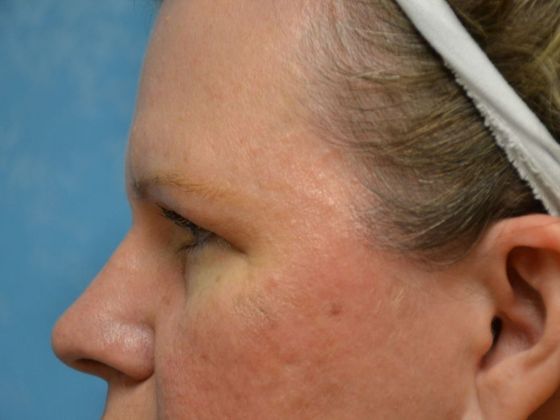 Eye Lift (Blepharoplasty): ULB1775 - Bowling Green, OH - Before