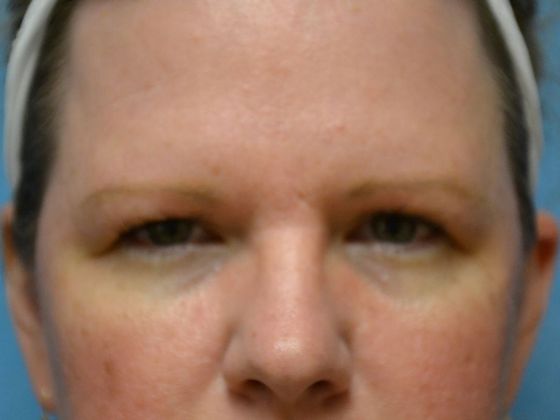 Eye Lift (Blepharoplasty) ULB1775 - Bowling Green, OH - Before