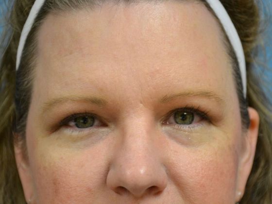 Eye Lift (Blepharoplasty) ULB1775 - Bowling Green, OH - After