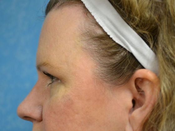 Eye Lift (Blepharoplasty): ULB1775 - Bowling Green, OH - After