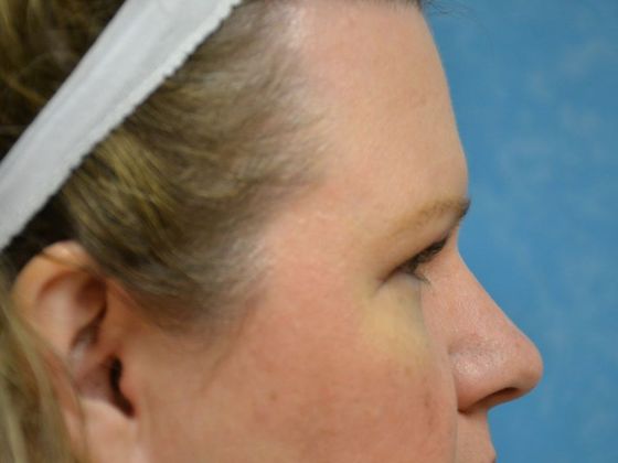 Eye Lift (Blepharoplasty): ULB1775 - Bowling Green, OH - After