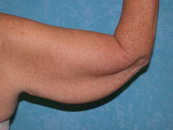 Arm Lift: BY1401 - Perrysburg, OH - Before