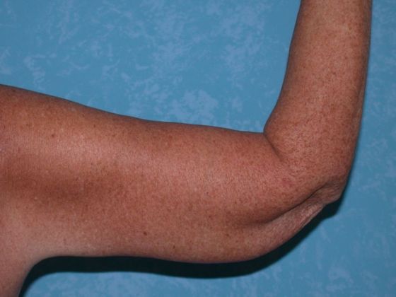 Arm Lift: BY1401 - Perrysburg, OH - After